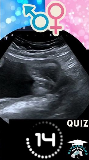 Ultrasound Quiz: Can You Guess? Boy or Girl? #ultrasound #babygenderprediction #baby