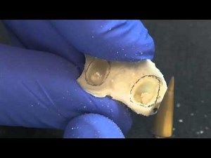 How to reline a processed Temporary by Dr. Marshall Fagin Prosthodontist