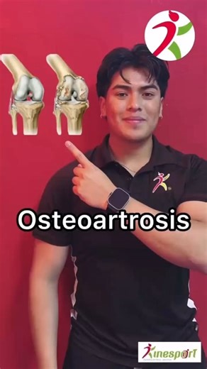 Kinesport® CDMX on Instagram: "Kinefriend, ¿Dejaste de ejercitarte porque te dijeron que tienes osteoartrosis de rodilla? El ejercicio bien indicado puede ayudarte 🦵 Nuestro fisioterapeuta Eduardo Cruz te explica por qué el fortalecimiento del cuádriceps ayuda a reducir el dolor y mejorar la función. Sigue nuestras indicaciones. Si tu dolor no mejora, contáctanos, nosotros podemos ayudarte. 📲 CONTÁCTANOS AHORA 📞 55 75 56 20 29 📚 Bibliografía: https://pubmed.ncbi.nlm.nih.gov/39728043/ #fisiot
