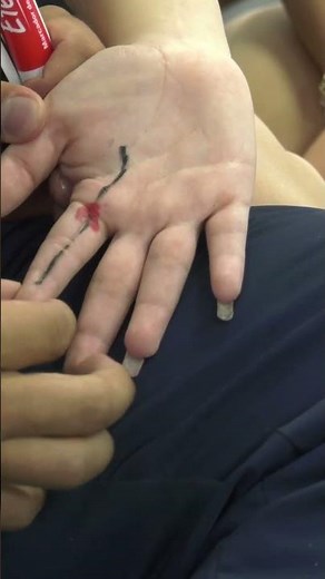 Trigger finger