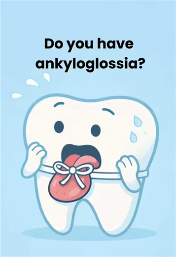 Dental Bits part 2: Ankyloglossia, also known as being “Tongue Tied” is a condition where the lingual frenum (cartilage under your tongue) is too short, restricting tongue movement. In extreme cases, a frenectomy is performed to help restore eating, breathing, and speech. This can be done at your dentists office. Follow for more ! 🦷🪥 #ankyloglossia #tonguetied #dentalstudent #predental #hygienist