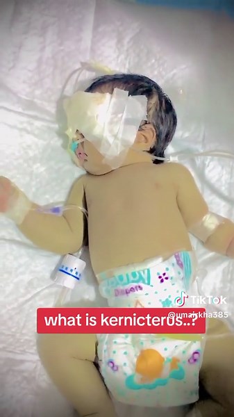 Understanding Kernicterus: Causes and Effects