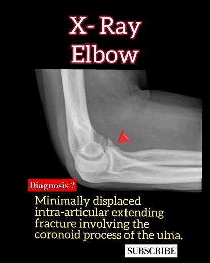 Coronoid process of the ulna fracture # ? Diagnosis # Radiology