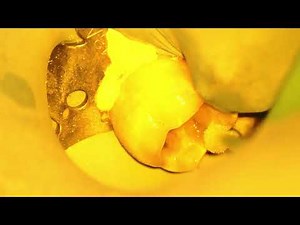 Composite sous microscope