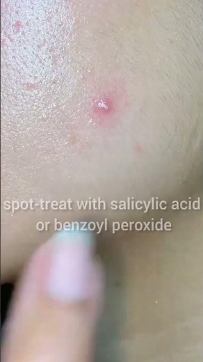 Teen Skincare 101 | Simple Routine for Clear Skin & Acne Treatment