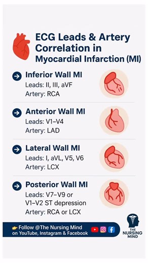 🫀 ECG Leads & MI Made Easy! Quick guide to correlate ECG changes with arterial involvement in Myocardial Infarction (MI). A must-know for students, nurses, and doctors preparing for exams & clinical practice! ✅ Save this for revision ✅ Share with your study buddies 👩‍⚕️👨‍⚕️ ⸻ 📌 Used AI to make this post #ECG #MyocardialInfarction #NursingStudents #MedicalNotes #MedSchool #MedLife #NursingExams #ECGInterpretation #Cardiology #NCLEX #NursingMind #NEETPG #USMLE #NORCET #MedStudy #MedicalEducati