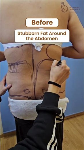 Signature Ab Contouring with 360° VASER Liposuction | Kaesthetics