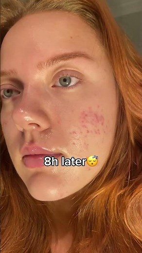 How to pop a pimple without scarring💙 #acneproneskin #acne