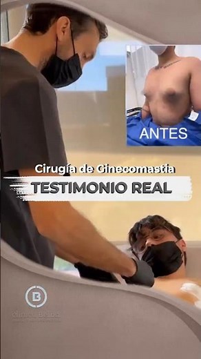 Gynecomastia Surgery | Real Testimonial of Subcutaneous Mastectomy