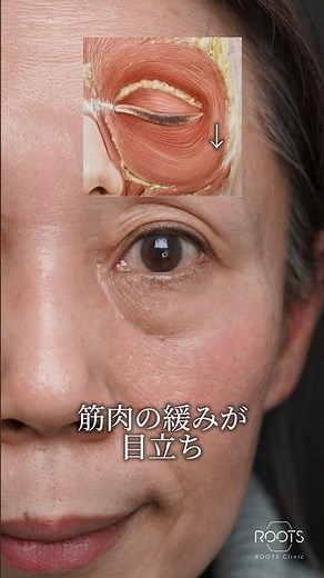 [Treating Under-Eye Circles in a Patient in Her 60s] #UnderEyeCircleTreatment #UnderEyeRemoval #U...