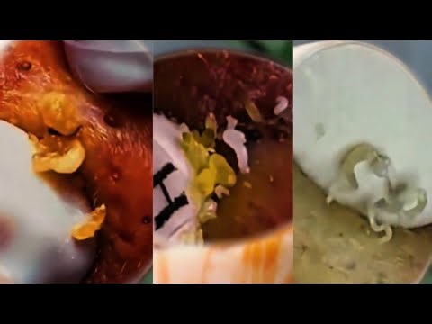 Most Satisfying Pimple Popping & Blackhead Removal Compilation | Oddly Relaxing ASMR 130