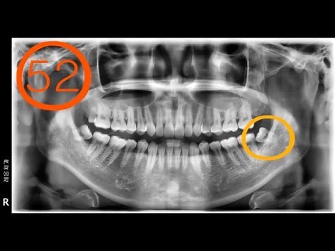 #38 Extraction of lower horizontal impacted wisdom tooth extraction