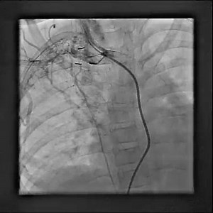 BT shunt 2 | Cardiology-Dr.AsifUllah