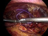Laparoscopic Subtotal Cholecystectomy -type V Mirrizi Syndrome • Video • MEDtube.net