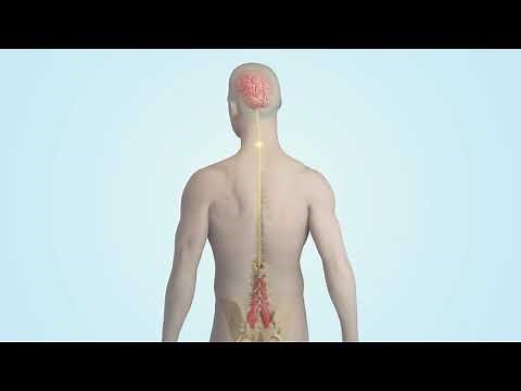 Mainstay Medical's ReActiv8 Therapy for Chronic Mechanical Low Back Pain.