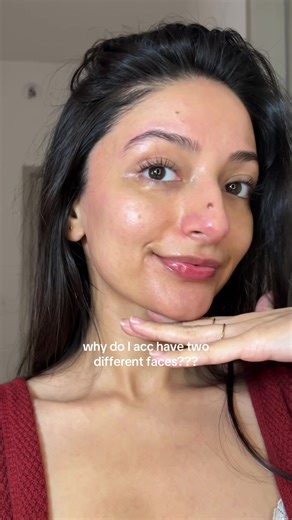 Understanding Rosacea and Facial Asymmetry