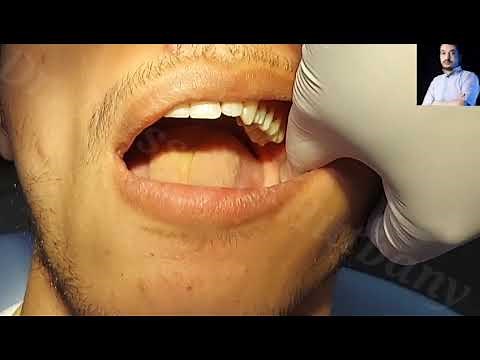 Local Anesthesia, Inferior Alveolar Nerve block Technique, mandibular nerve block Technique #dentist