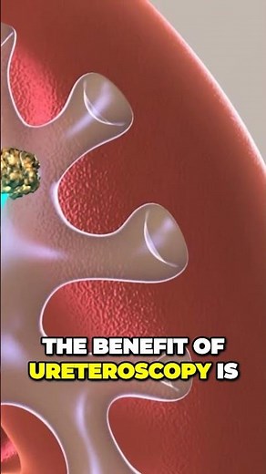 Ureteroscopy is a minimally invasive procedure to treat kidney stones and stones in the ureter.