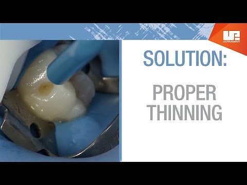 Three Common Reasons Bonded Restorations Fail