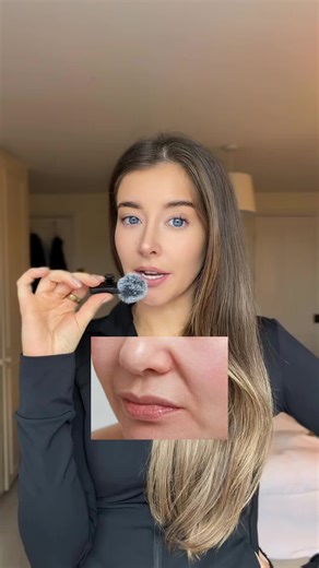 I get so many questions about nasolabial folds! They become more prominent as we age due to the descent of facial fat pads and loss of volume in the midface. As the malar (cheek) fat pads shift downward, they can create a heavier fold. If you’re looking to soften them, there are several effective options: dermal fillers can restore lost, a facelift can reposition descended fat pads and tighten underlying tissues for longer-lasting results, thread lifts offer a less invasive lifting option, and t