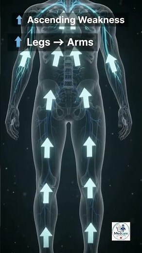 Why is Weakness Moving Upward? | Guillain-Barré Syndrome (GBS) Explained