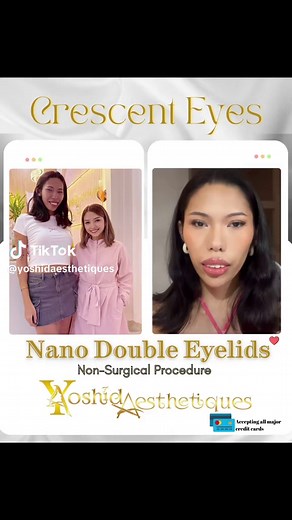 Nano Double Eyelid Procedure: Non-Surgical Enhancement