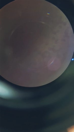 Normocytic normochromic Anemia with Neutrophilic Leukocytosis. | Wali Rehman Clinical Laboratory