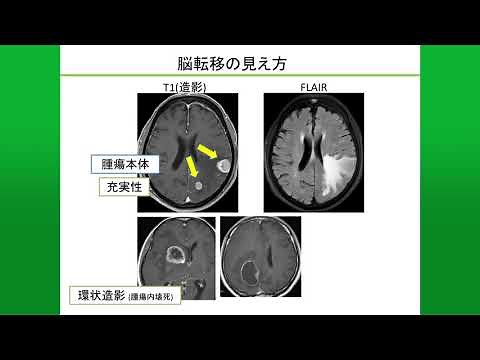 がんの脳への転移と治療