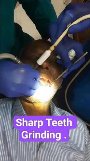 Sharp teeth grinding treatment . ♥️♥️ #dr. prodip roy #dentalsurgeon #smiledesigndental