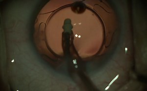 Standard Cataract Surgery - Eyetube