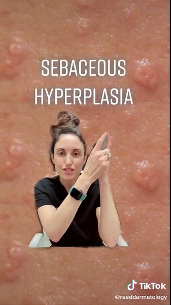 Understanding Sebaceous Hyperplasia: Top Knot Talks with Dr. Reed