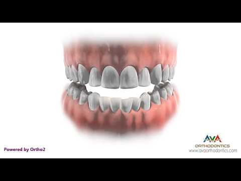 Orthodontics Treatment with Extraction - Removing Different Teeth