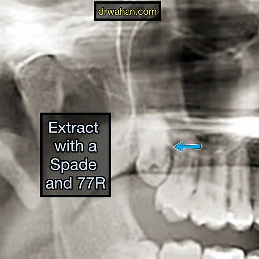 Upper Wisdom Tooth Extraction with 2 Elevators