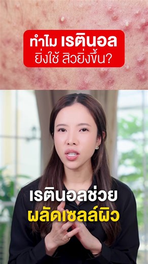 เรตินอลดีจริงไหม? ความเชื่อและความจริงเกี่ยวกับสิว