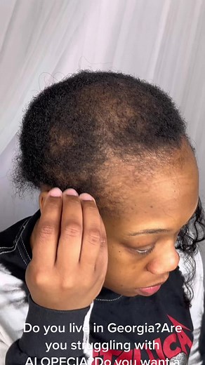 Alopecia Braiding Solutions: Stylish Hair for All