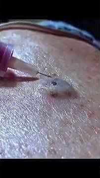 Removing large blackheads and pimples from face new 2026 #46