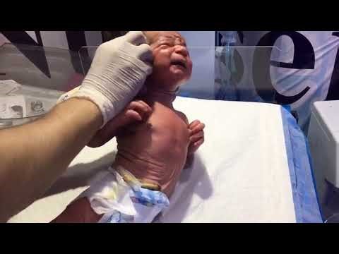 Meconium (MSL) Baby Care After C-Section | NICU Cleaning & Management