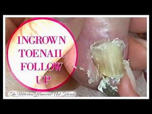 Extreme Ingrown Toenail Pedicure Tutorial Toenail Transformation