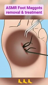 198K views · 512 reactions | ASMR Foot Maggots removal & treatment | #3danimation #satisfying #trending #cleaning #reels #shorts #asmr #animation | Akhilesh Yadav | Facebook