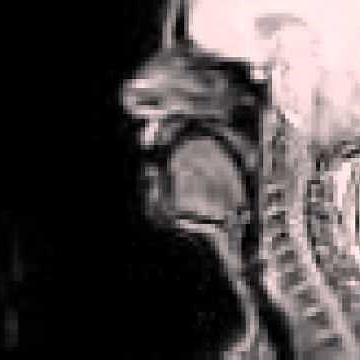 Voiced uvular trill MRI