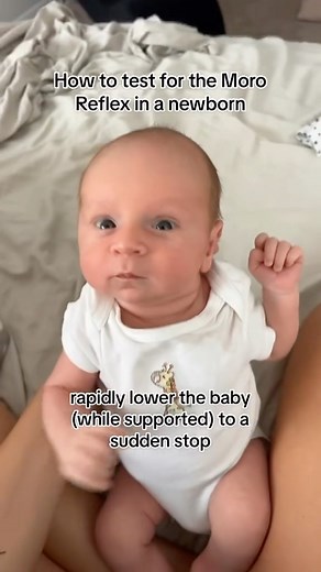 Gabriella Shelley | Pediatric Occupational Therapist on Instagram: "The Moro reflex is a primitive reflex that develops between 28 and 32 weeks of gestation and disappears at 3–6 months of age. It is a response to a sudden loss of support and involves three distinct components: spreading out the arms, pulling the arms in as the reflex ends, and crying (usually). The primary significance of the Moro reflex is in evaluating integration of the central nervous system. Absence of Moro or a sustained 