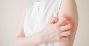 Wyprysk fotoalergiczny - przyczyny, objawy i leczenie