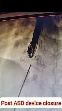 ASD device closure procedure, https://youtu.be/UgQurjWrPvk?si=GNBI6PoCZ9FMd0b0