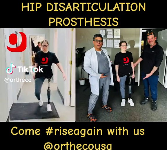 This girl is beating the odds with her new hip disarticulation prosthesis. @martinbionics socket and @ossur Rheo Knee Come #riseagain with us @orthecousa #hipdisarcitulation #hipdisarticilationamputee #stl #stlmade #prostheticleg #prosthesis #amputee #amputeelife #amputeesuccess #bionic #bionichand #prosthetics #stlouis #amputationsurgery #amputation #amputeestlye #comfort #prosthetic #prosthetics #belowkneeprosthesis #abovekneeprosthesis #abovekneeamputee #aboveknee #belowkneeamputee #capegirar