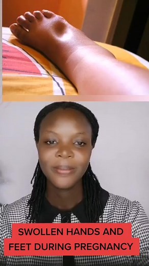 23K views · 394 reactions | SWOLLEN HANDS AND FEET DURING PREGNANCY DO SIGN UP FOR OUR PREGNANCY CLASS TO LEARN MORE 0242281957 | Midwife Sally | Facebook