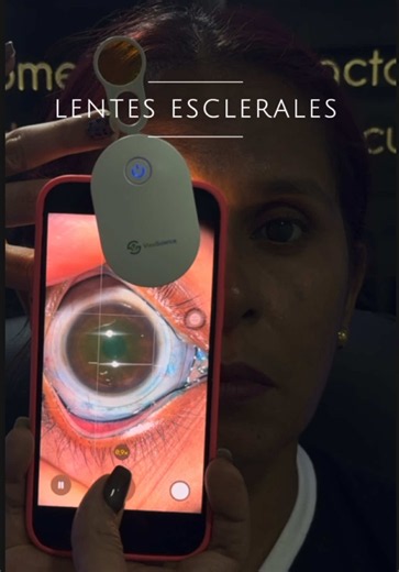 Lentes de contacto escleral multifocal para miopía magna, astigmatismo y presbicia
