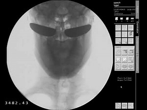 Chin Tuck Swallowing Strategy - Modified Barium Swallow Study (MBSS) Anterior/Posterior View HD
