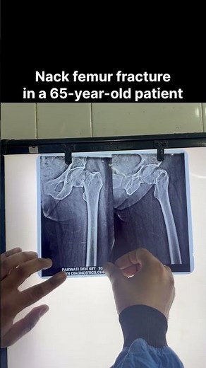 #HipReplacement #Hemiarthroplasty #HipFracture #OrthopedicSurgeon #DrDhruvSharma