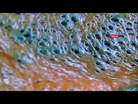 Solar Comedones and Blackheads - Blackhead King