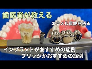 インプラントがいい場合 ブリッジがいい場合 ー インプラント相談は当院まで